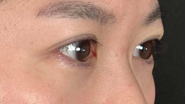 手術前の状態 その1