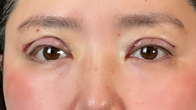 手術前の状態 その1