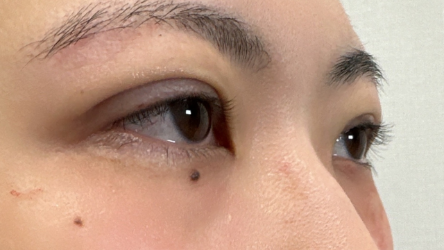 手术前的状态 其一