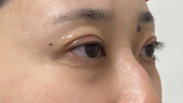 手术前的状态 其一