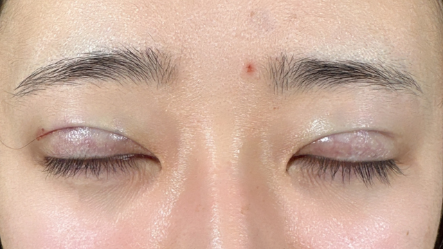 手术前的状态 其一