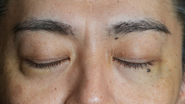 手術前の状態 その1