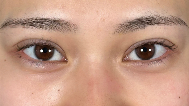 手术前的状态 其一