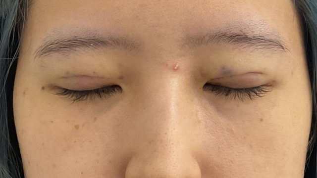 手術前の状態 その1