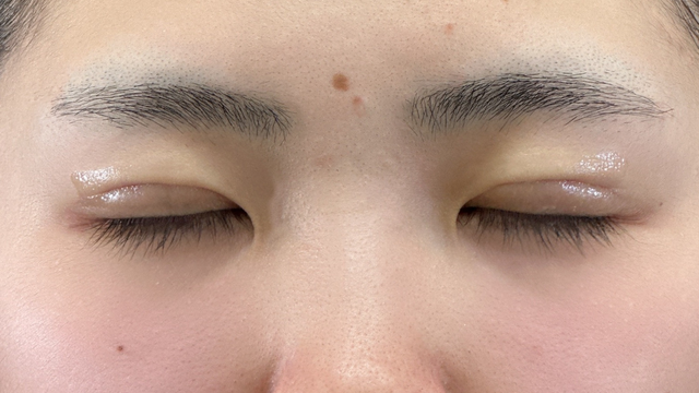 Postoperative Condition Part 1