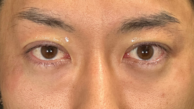 手术前的状态 其一