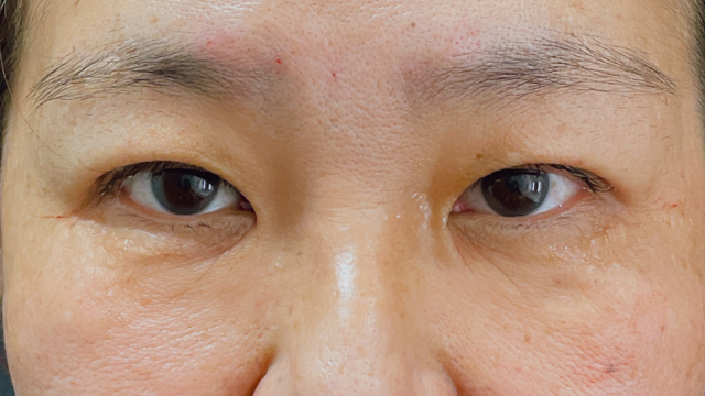 Postoperative Condition Part 1