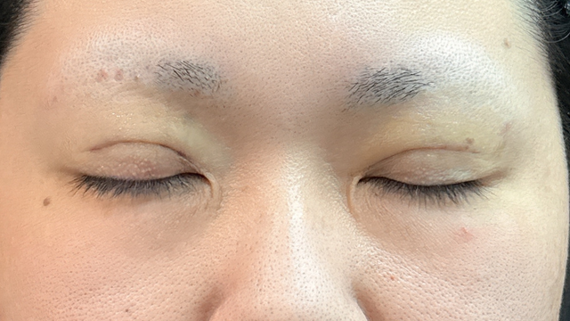 手術前の状態 その1