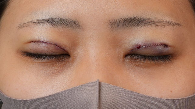 手術前の状態 その1