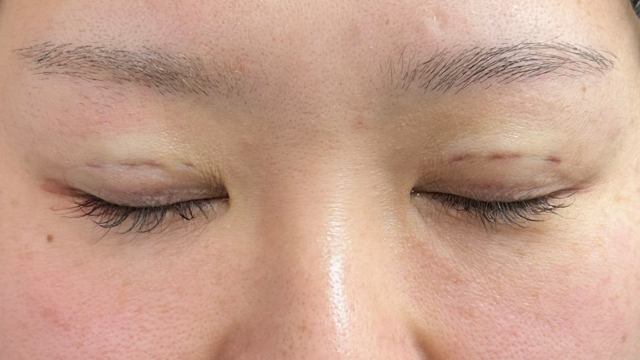 手术前的状态 其一