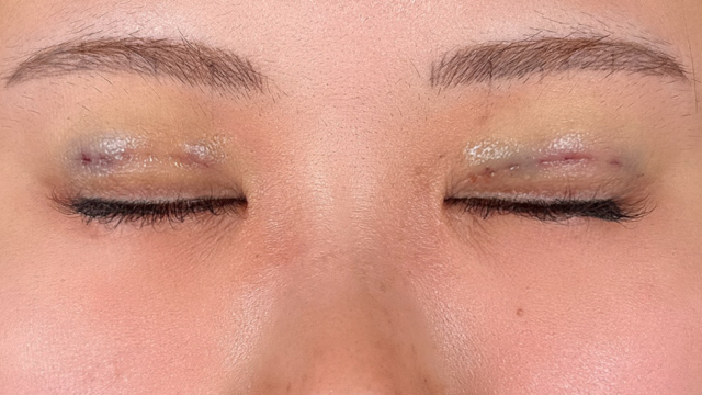 手术前的状态 其一