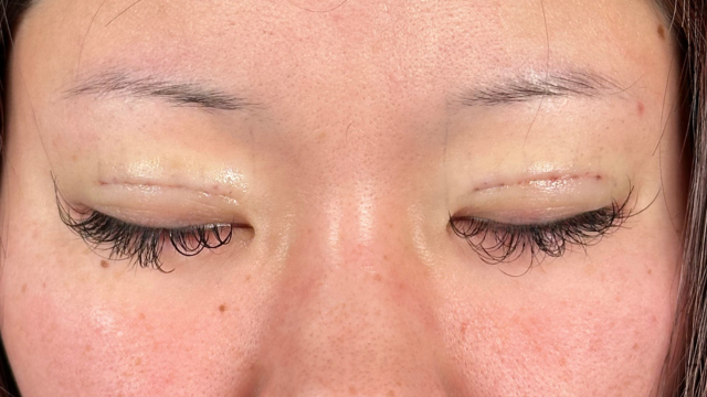 手术前的状态 其一