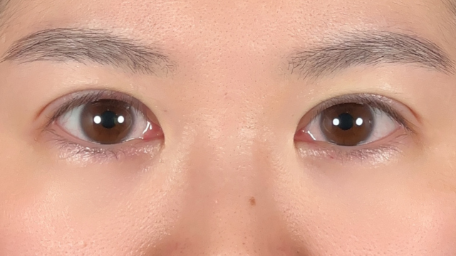 手術前の状態 その1