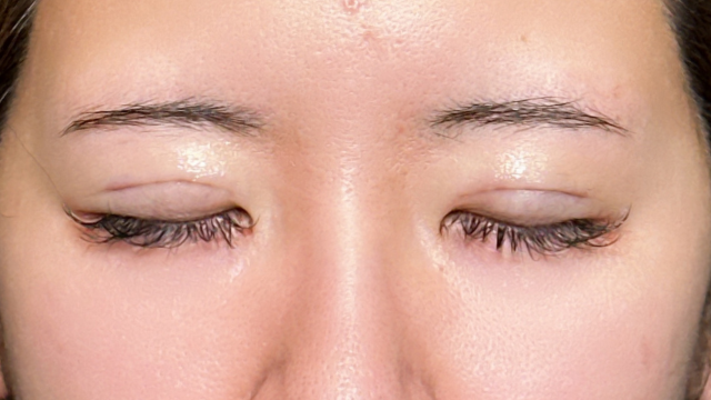 手术前的状态 其一