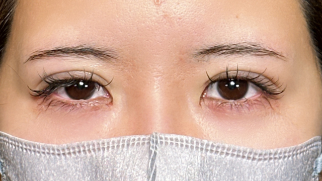 手术前的状态 其一