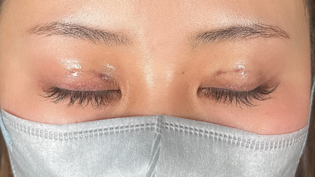 手术前的状态 其一