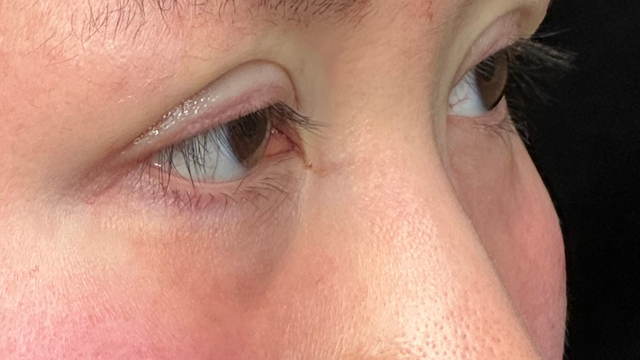 Postoperative Condition Part 1