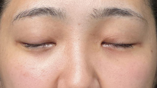 Postoperative Condition Part 1