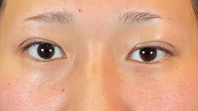 手術前の状態 その1