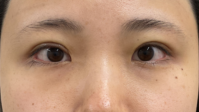 手术前的状态 其一