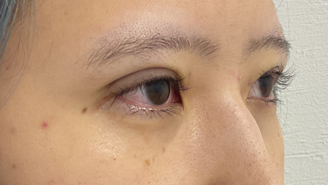 手術前の状態 その1