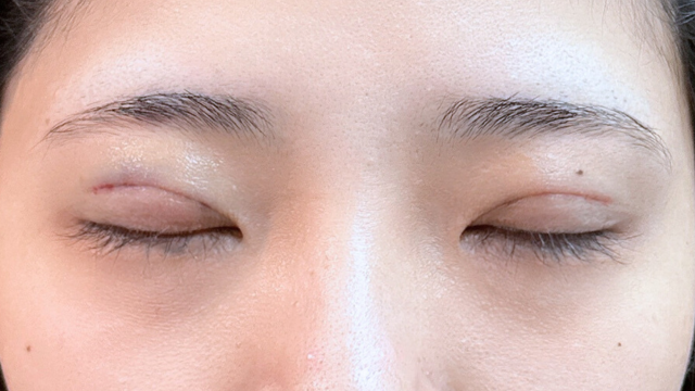 Postoperative Condition Part 1