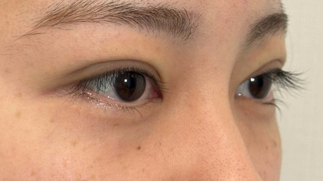 手术前的状态 其一