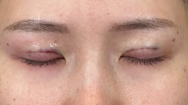 手术前的状态 其一