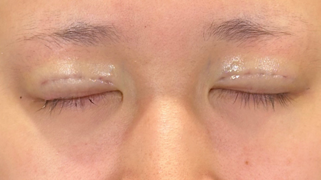 手术前的状态 其一