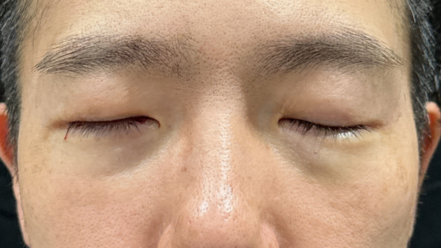 手术前的状态 其一