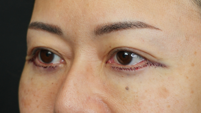 Postoperative Condition Part 1