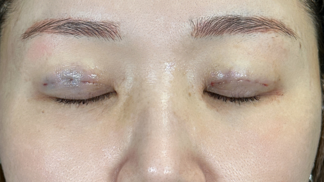 手術前の状態 その1