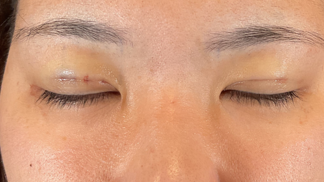 手术前的状态 其一