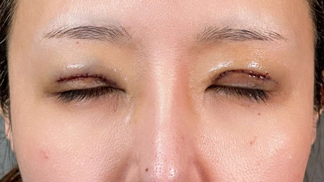 手術前の状態 その1