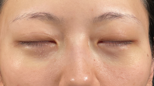 手术前的状态 其一