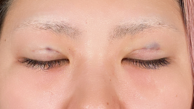 手术前的状态 其一