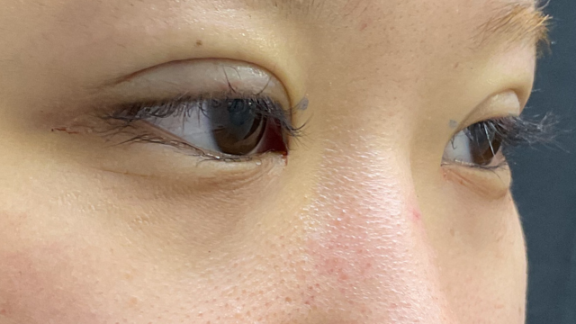 手術前の状態 その1