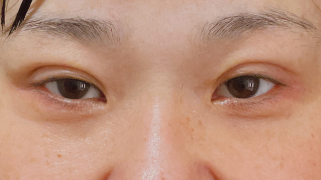 Postoperative Condition Part 1