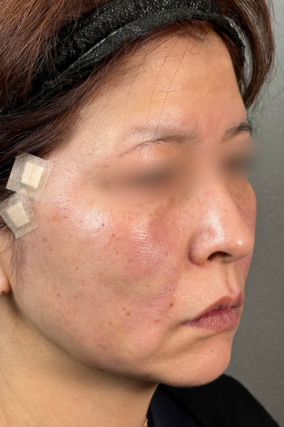 手術前の状態 その1