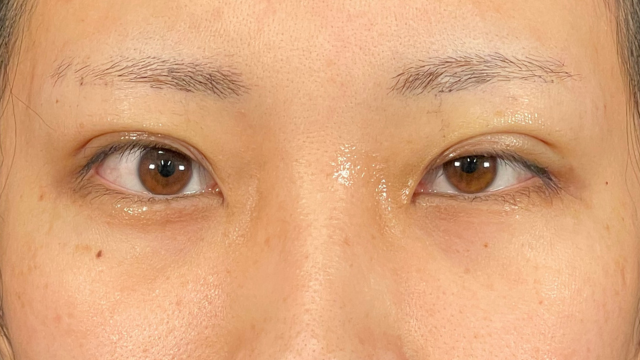 手術前の状態 その1