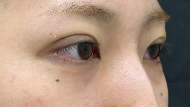 手术前的状态 其一