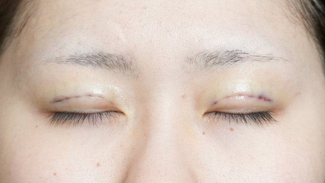 手术前的状态 其一