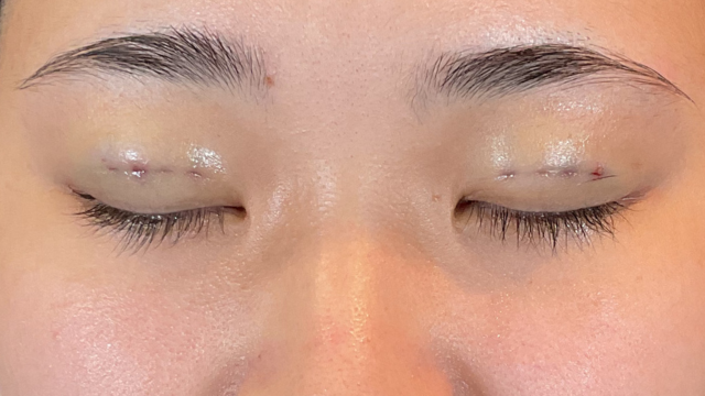 手術前の状態 その1