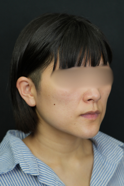 手術前の状態 その1