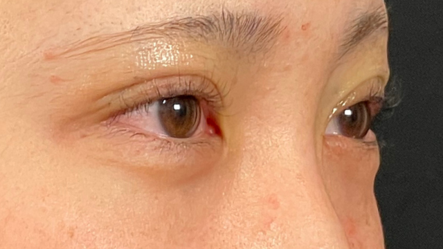 手术前的状态 其一