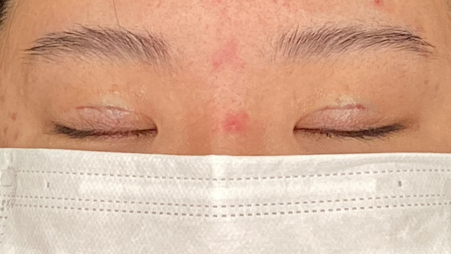 手術前の状態 その1