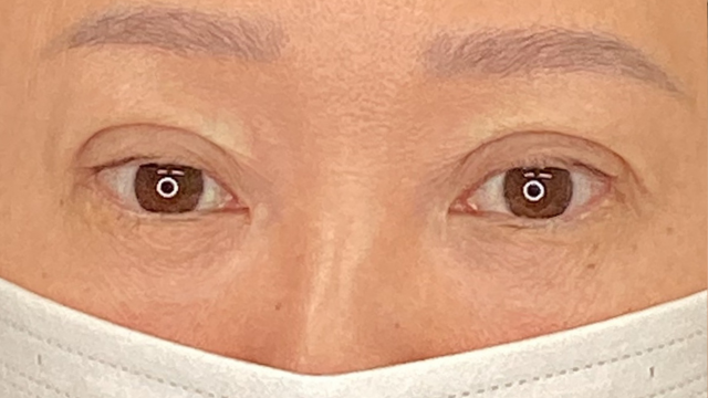 手術前の状態 その1