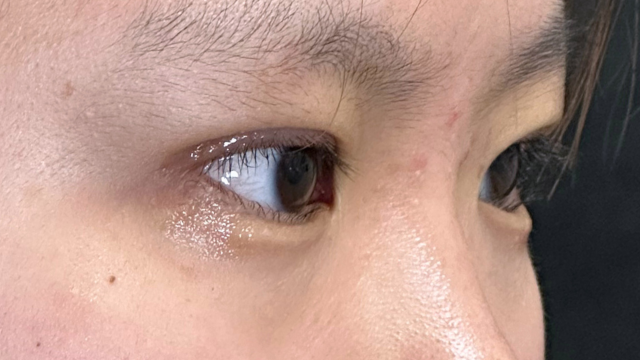 手术前的状态 其一