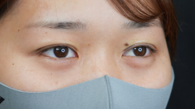 手術前の状態 その1