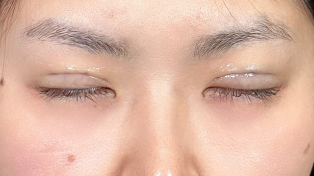 手术前的状态 其一